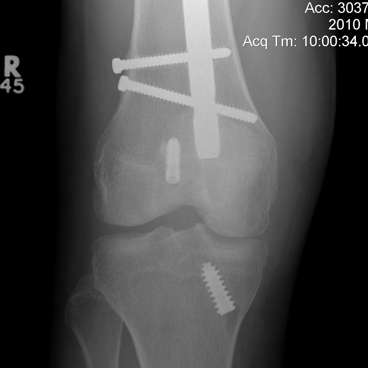 Femoral Fracture + ACL Reconstruction